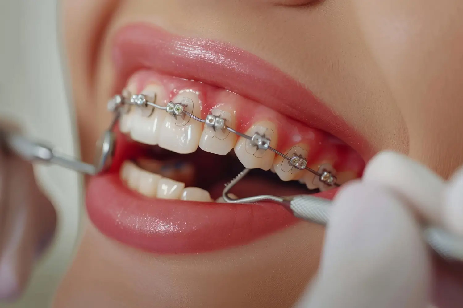 Braces consultation — Delhi teen orthodontic treatment