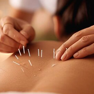 Acupuncture Therapist